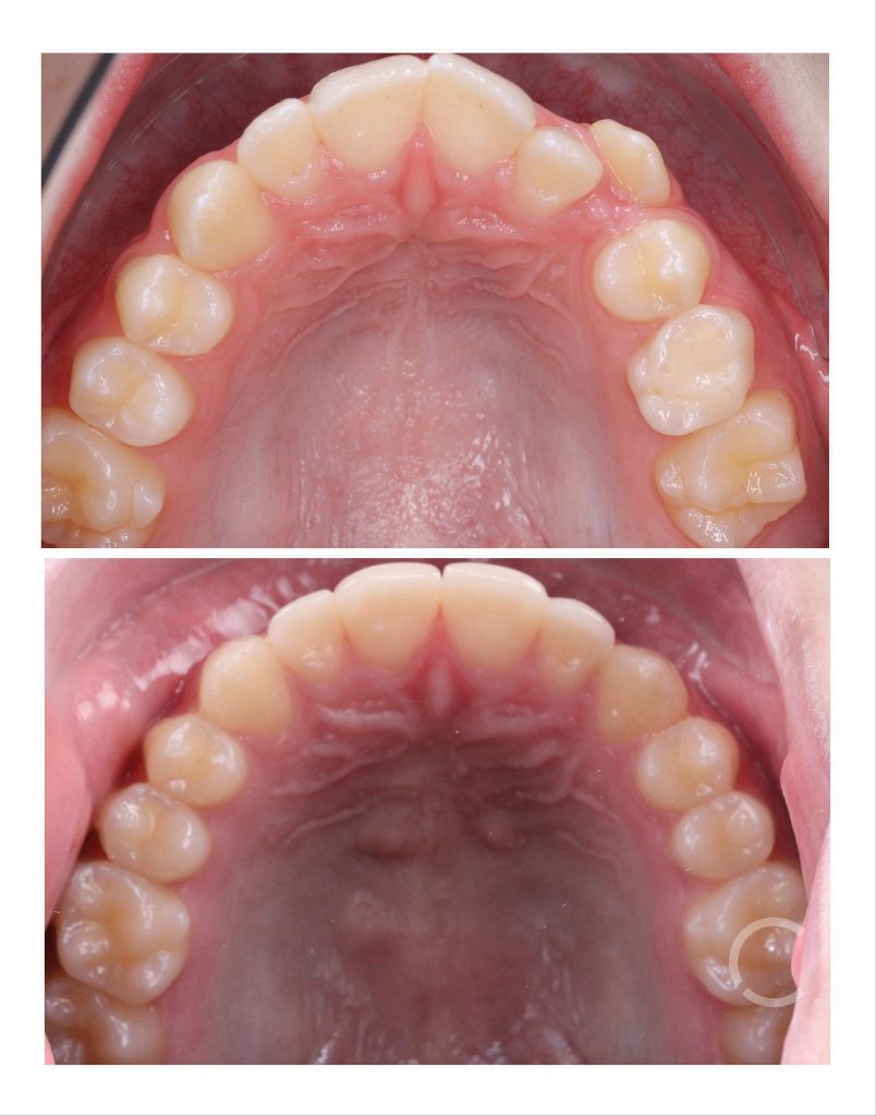 dome mini before and after