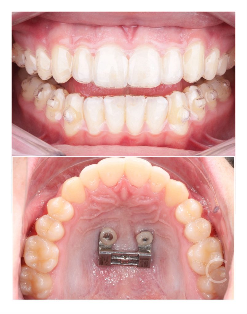 dome mini+ before and after