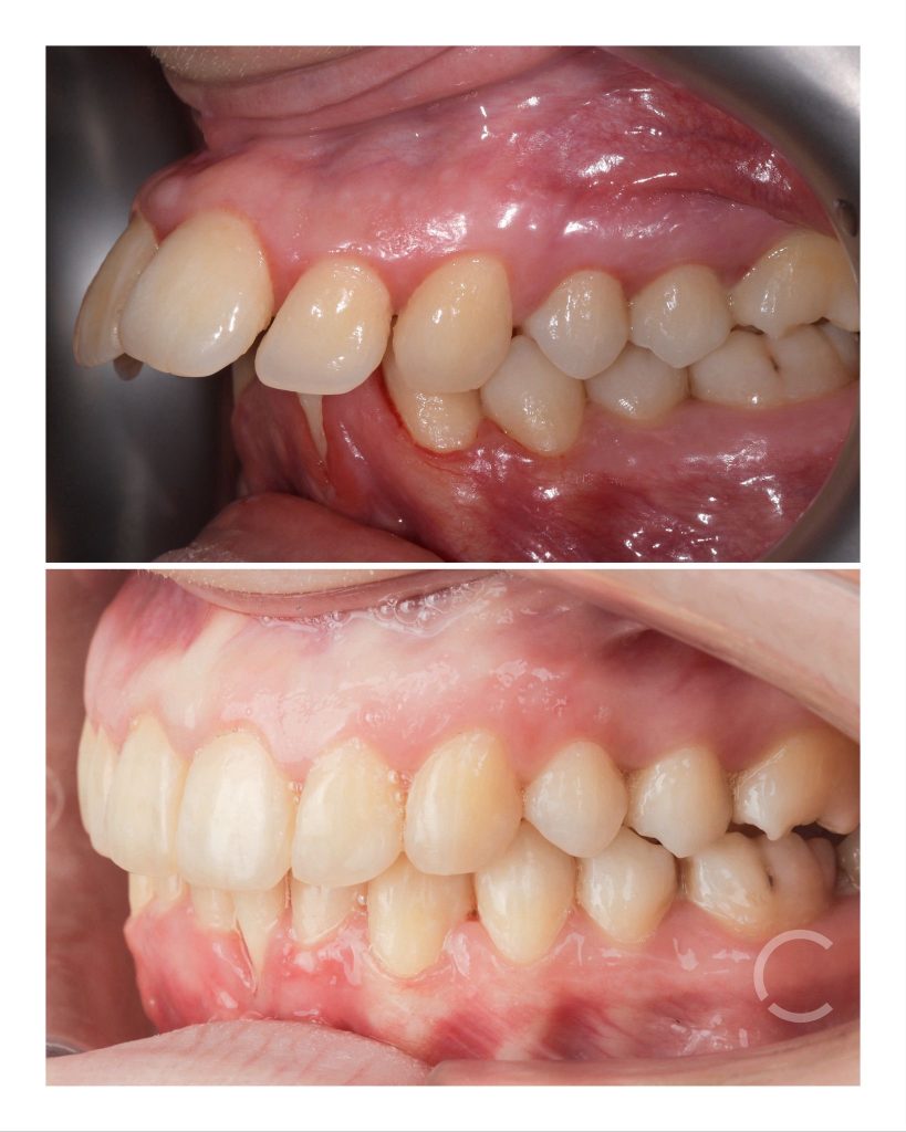 dome zero before and after
