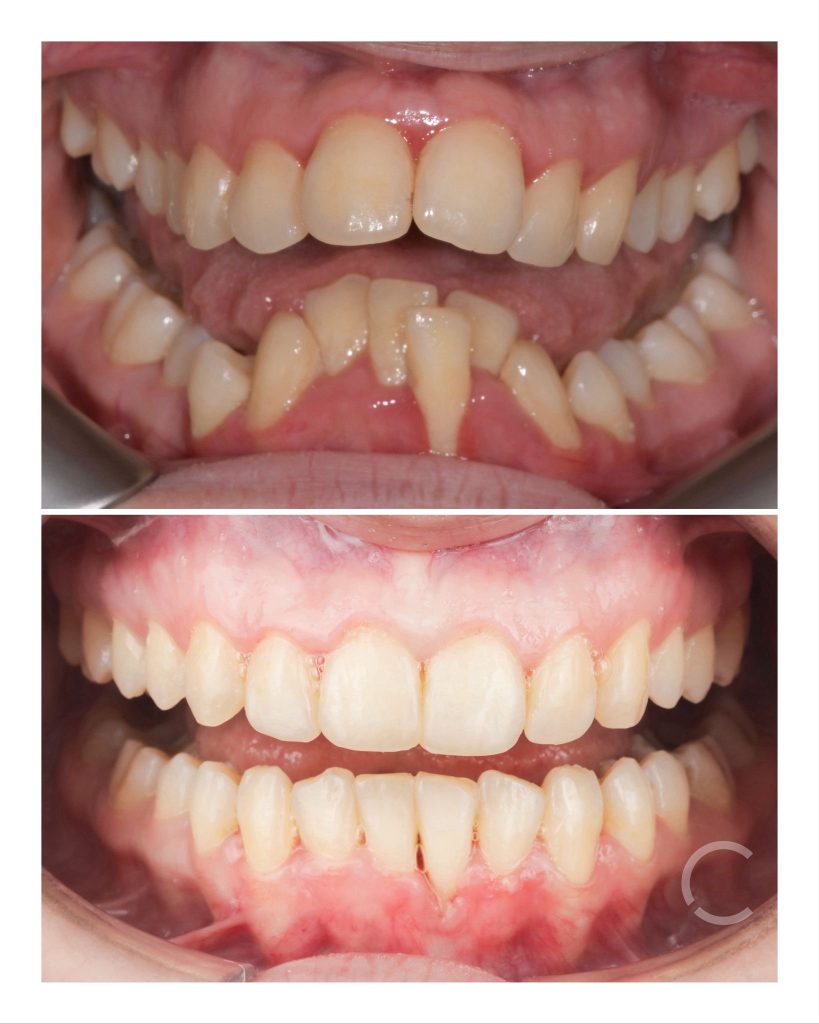 dome zero before and after 2
