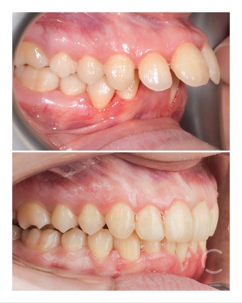 dome zero before and after 3